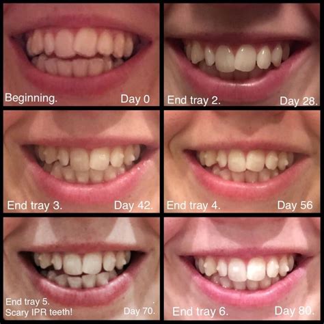 invisalign results after 1 month|invisalign week by week progression.